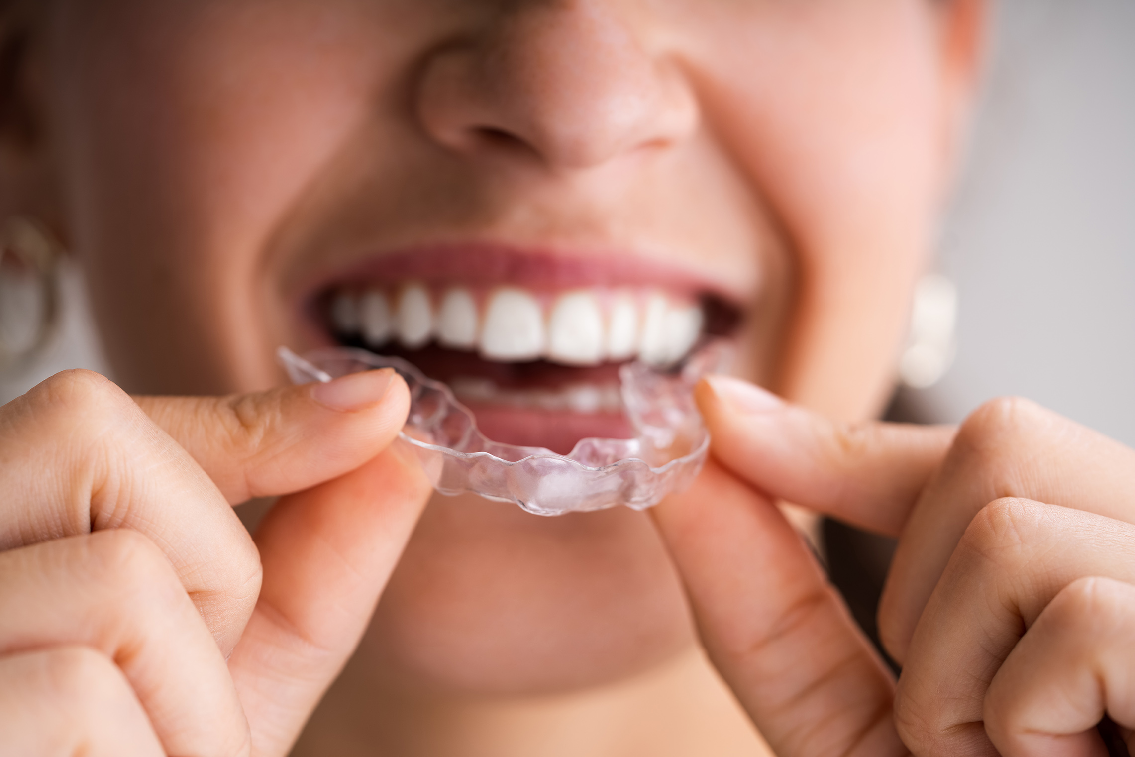 invisalign clear aligner in medford